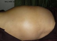 BỆNH XƠ GAN CỔ TRƯỚNG