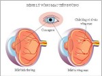 Biến chứng mắt có thể gây mù lòa ở bệnh nhân đái tháo đường
