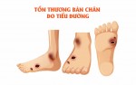 Biến chứng nguy hiểm ở bàn chân khi mắc bệnh đái tháo đường
