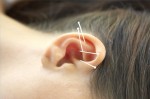 Châm cứu chữa điếc tai vô cùng nguy hiểm nếu làm không đúng cách