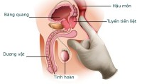 VIÊM TUYẾN TIỀN LIỆT